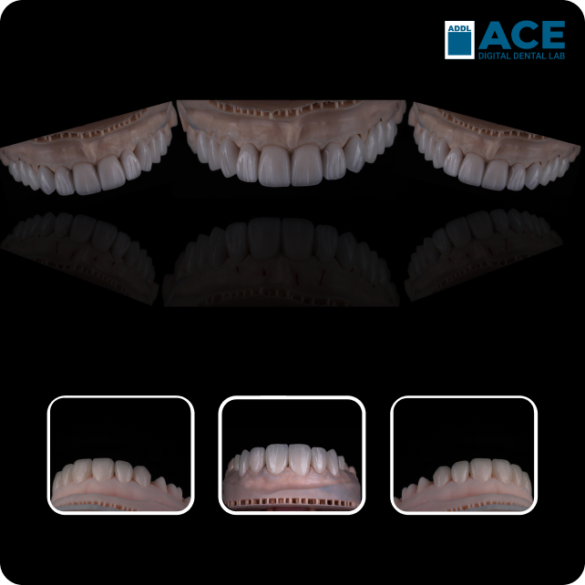 crown-bridges-solution-img